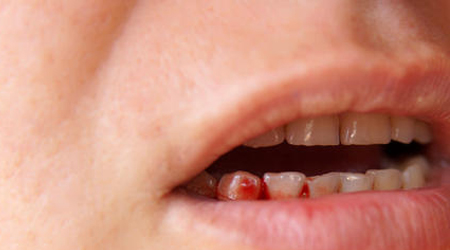 بند آوردن خون دندان پس از کشیدن