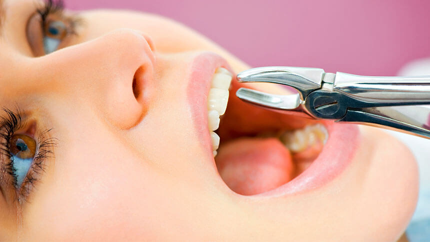 مراقبت پس از کشیدن دندان