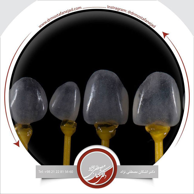 لومینیرز نازک