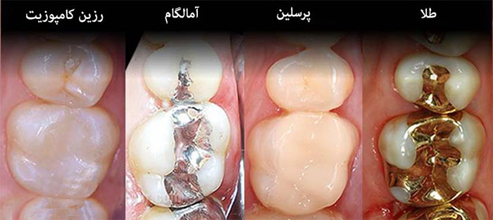 پرکردن دندان