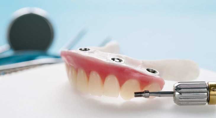 اوردنچر چیست