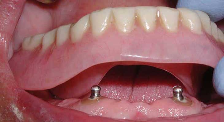 اوردنچر چیست