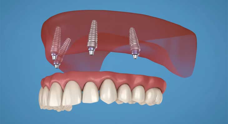 ایمپلنت فک بالا