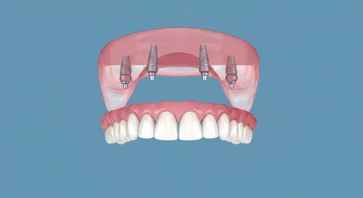 ایمپلنت فک بالا