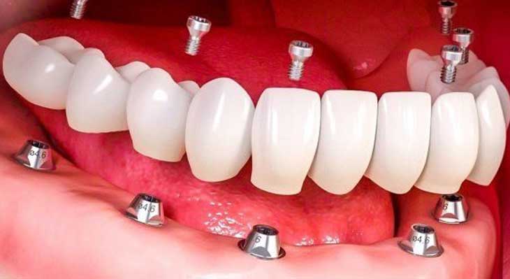 ایمپلنت فک پایین