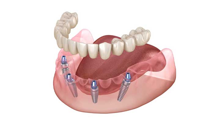 ایمپلنت فک پایین