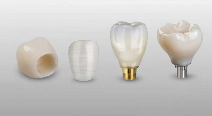 تعویض روکش و تاج ایمپلنت