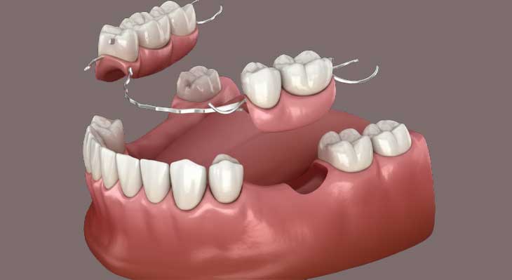 کاشت دندان بدون ایمپلنت