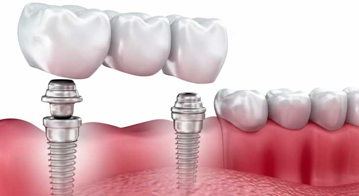 بریج بر پایه ایمپلنت