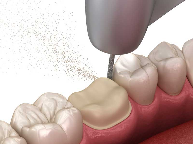 روکش موقت دندان چیست؟