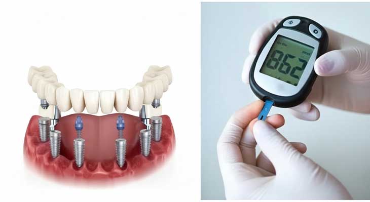ایمپلنت برای افراد دیابتی