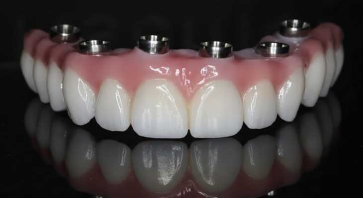 تعداد ایمپلنت برای هر فک