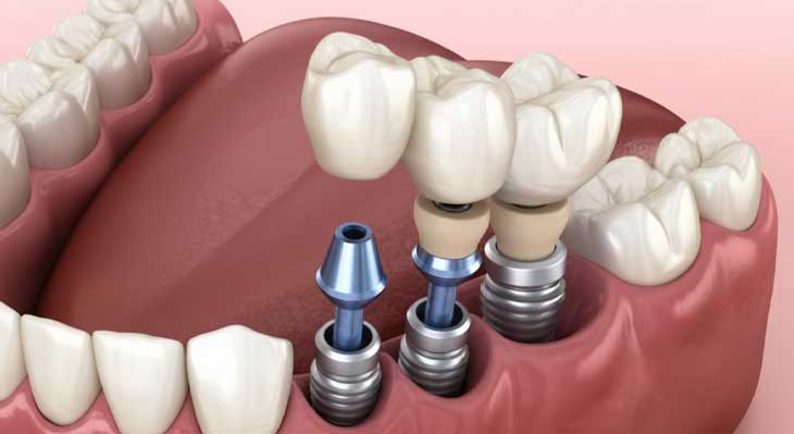 تعویض روکش و تاج ایمپلنت