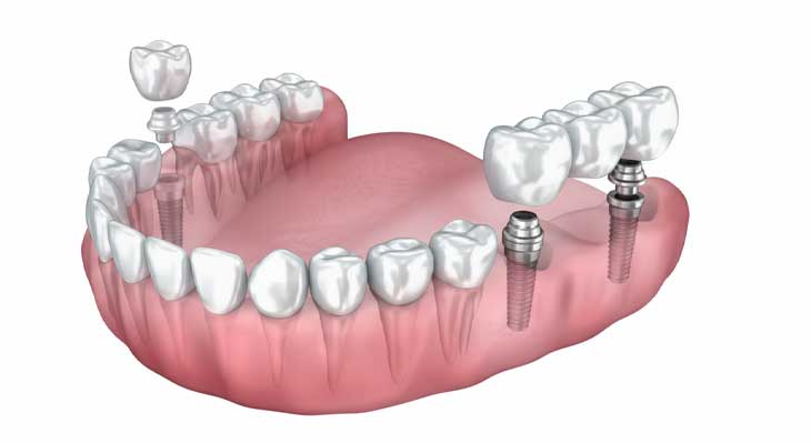 بریج بر پایه ایمپلنت