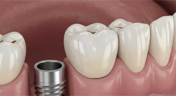 جایگزینی دندان از دست رفته