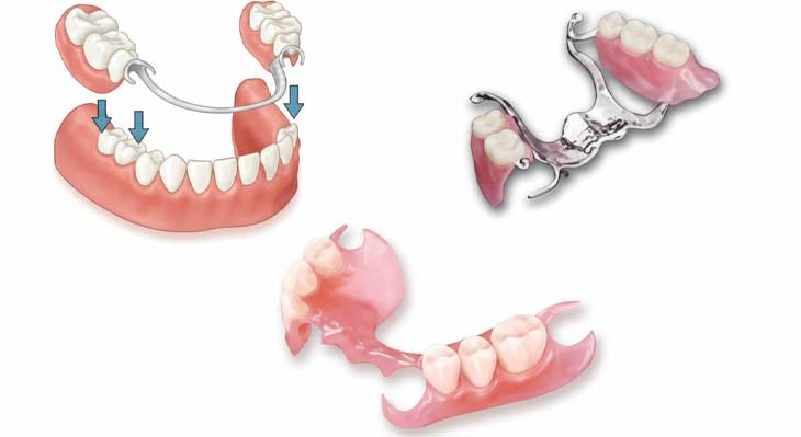 کاشت دندان بدون ایمپلنت