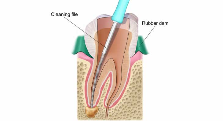 درمان ریشه دندان