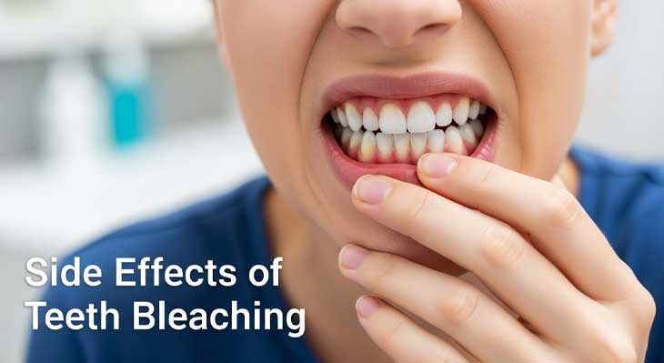 عوارض بلیچینگ دندان