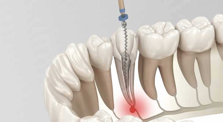 درمان ریشه دندان