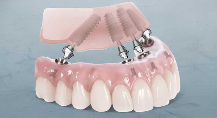 ایمپلنت all-on-4