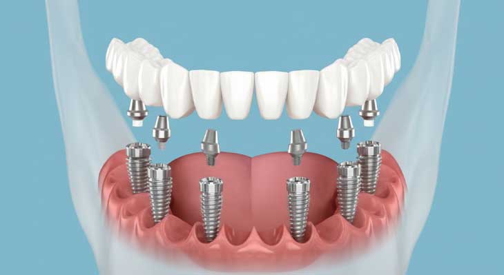 ایمپلنت all-on-6