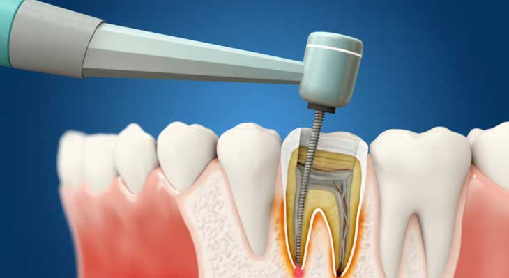 درمان ریشه دندان