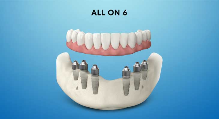 ایمپلنت all-on-6