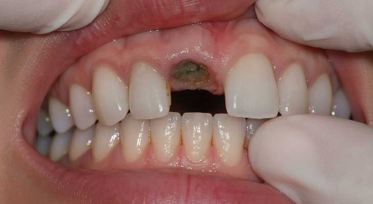 ریشه دندان شکسته