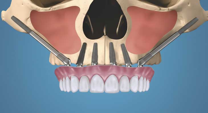 ایمپلنت زیگوماتیک
