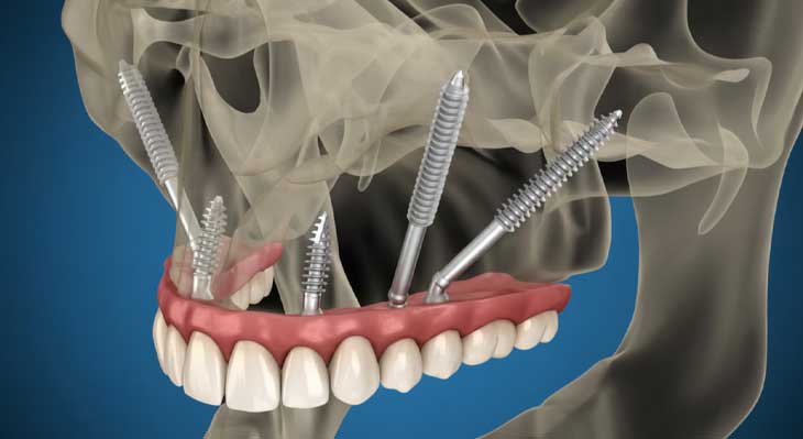 ایمپلنت زیگوماتیک