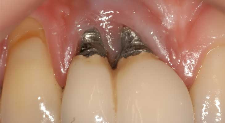 پری ایمپلنتایتیس