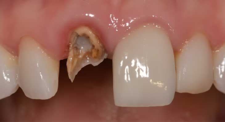 ریشه دندان شکسته