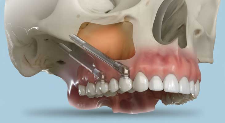 ایمپلنت زیگوماتیک