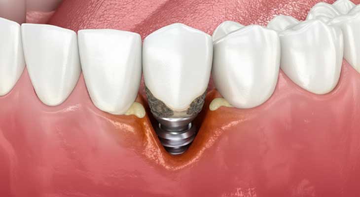 پری ایمپلنتایتیس