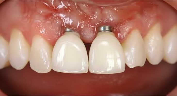 شکست و عدم موفقیت در ایمپلنت دندان