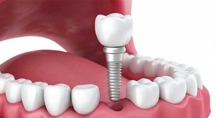 تعویض ایمپلنت دندان