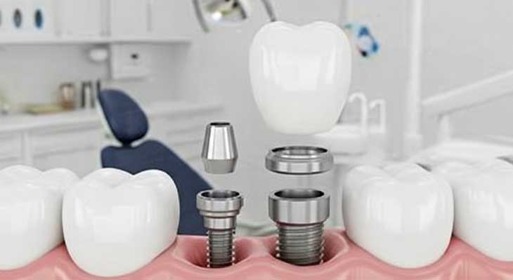 کاشت مجدد ایمپلنت