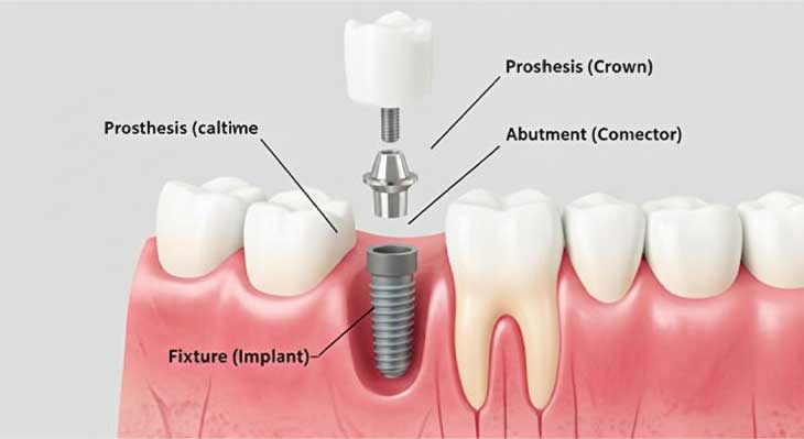 تعویض ایمپلنت دندان