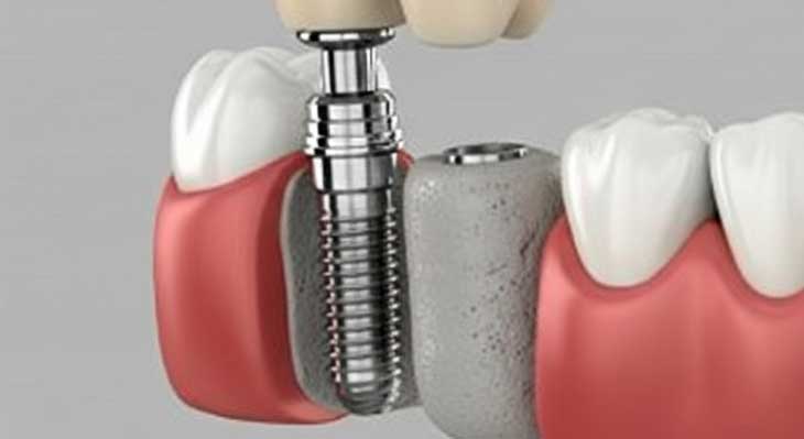 بازسازی استخوان فک