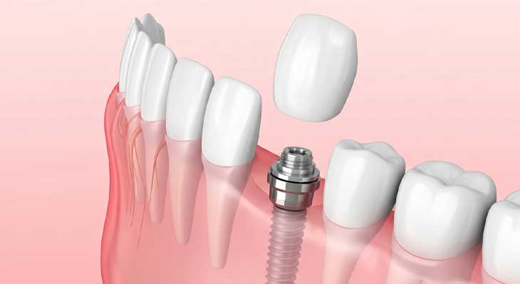 تعویض ایمپلنت دندان