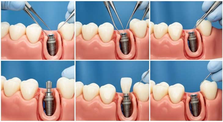 کاشت مجدد ایمپلنت