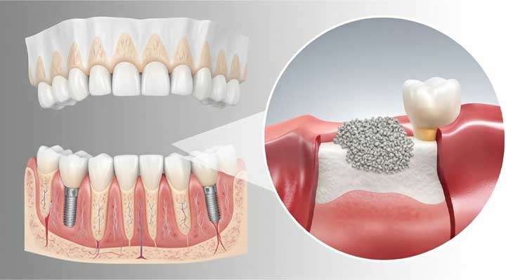 بازسازی استخوان فک